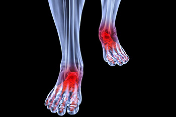 arthritic foot care in the St. Charles County, MO: Saint Peters (O'Fallon, St Charles, Wentzville, Lake St Louis, Dardenne Prairie, Cottleville, Weldon Spring) and St. Louis County, MO: Maryland Heights, Bridgeton, Earth City areas