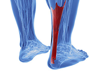 achilles tendon treatment in the St. Charles County, MO: Saint Peters (O'Fallon, St Charles, Wentzville, Lake St Louis, Dardenne Prairie, Cottleville, Weldon Spring) and St. Louis County, MO: Maryland Heights, Bridgeton, Earth City areas