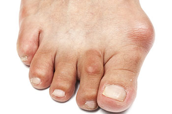 bunions treatment in the St. Charles County, MO: Saint Peters (O'Fallon, St Charles, Wentzville, Lake St Louis, Dardenne Prairie, Cottleville, Weldon Spring) and St. Louis County, MO: Maryland Heights, Bridgeton, Earth City areas