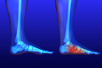 flat feet treatment in the St. Charles County, MO: Saint Peters (O'Fallon, St Charles, Wentzville, Lake St Louis, Dardenne Prairie, Cottleville, Weldon Spring) and St. Louis County, MO: Maryland Heights, Bridgeton, Earth City areas