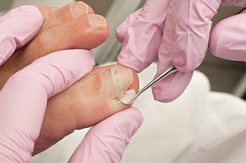 ingrown toenail treatment in the St. Charles County, MO: Saint Peters (O'Fallon, St Charles, Wentzville, Lake St Louis, Dardenne Prairie, Cottleville, Weldon Spring) and St. Louis County, MO: Maryland Heights, Bridgeton, Earth City areas