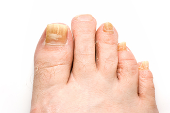 Fungal toenails  treatment in the St. Charles County, MO: Saint Peters (O'Fallon, St Charles, Wentzville, Lake St Louis, Dardenne Prairie, Cottleville, Weldon Spring) and St. Louis County, MO: Maryland Heights, Bridgeton, Earth City areas