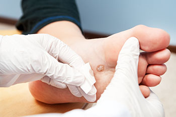 plantar warts treatment in the St. Charles County, MO: Saint Peters (O'Fallon, St Charles, Wentzville, Lake St Louis, Dardenne Prairie, Cottleville, Weldon Spring) and St. Louis County, MO: Maryland Heights, Bridgeton, Earth City areas