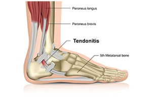 Managing Achilles Tendon Injuries