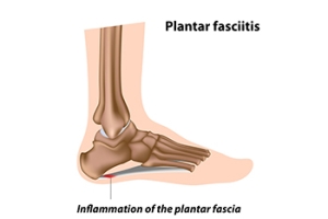 Getting Help for Plantar Fasciitis