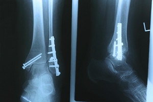 How an Ankle Fracture Can Disrupt Life