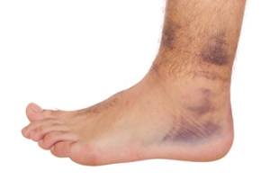 Causes and Grades of Ankle Sprains